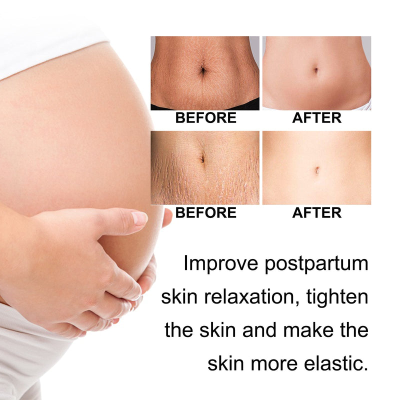 Ouhoe Pregnancy Care Cream Moisturizes And Restores Fine Lines Of Postpartum Skin To Firm, Soft And Smooth Body Skin
