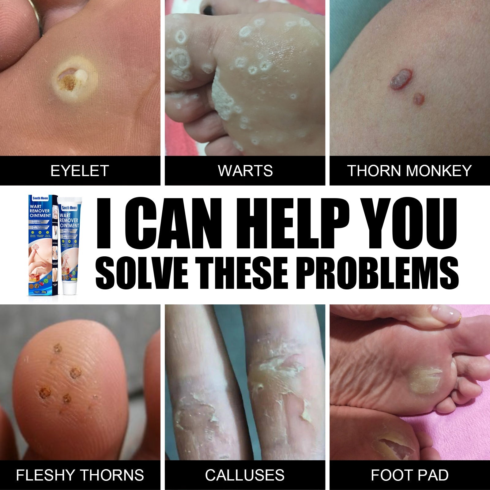 Wart Remover Cream, Grains Neck Filamentous Brothers Face Alar Tame Hou Warts