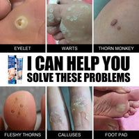 Wart Remover Cream, Grains Neck Filamentous Brothers Face Alar Tame Hou Warts