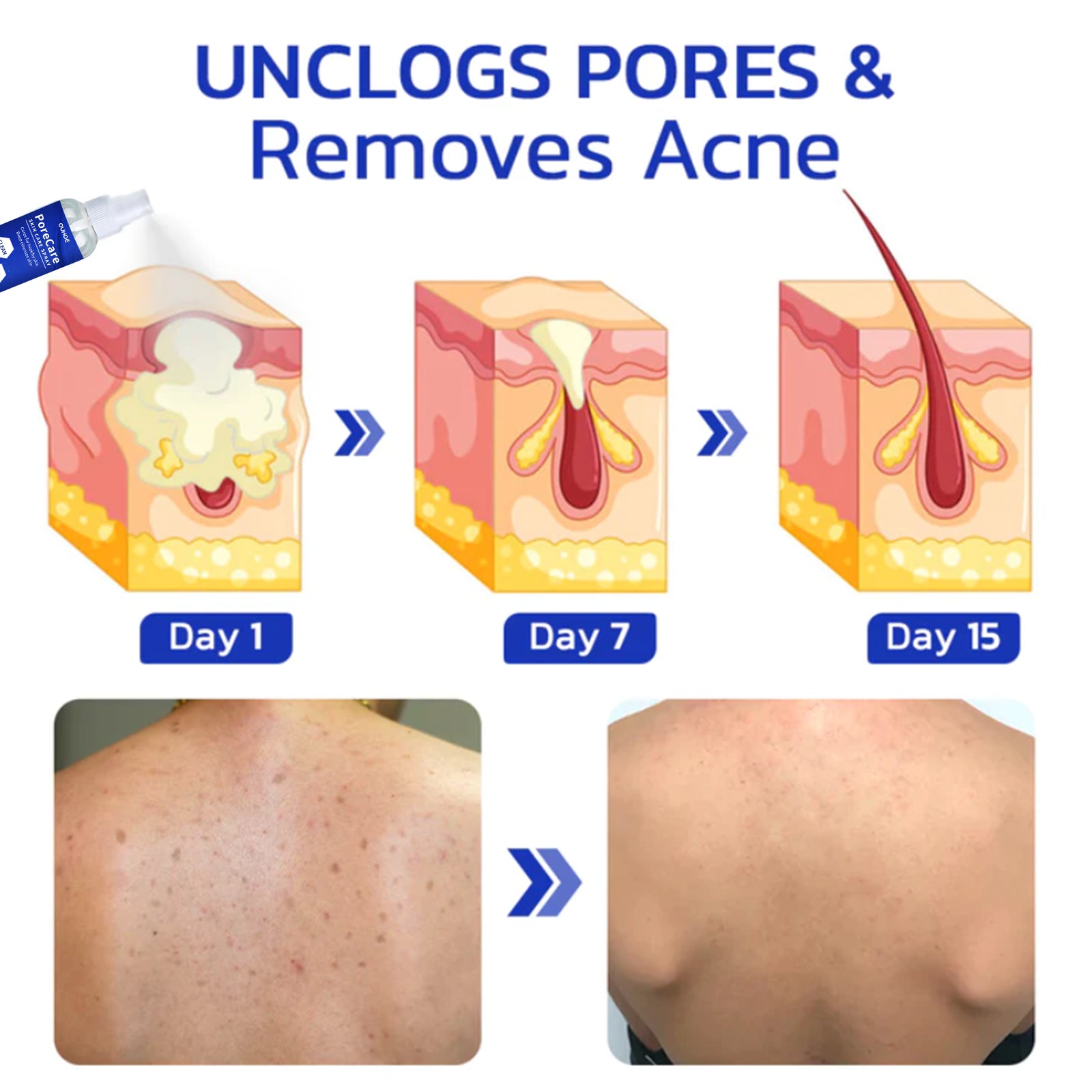 Porecare Skin Care Spray, Cleanser Warts Fade Moles Corns Smooth Skin Care Spray