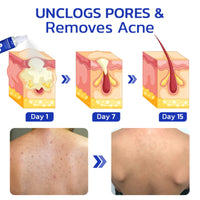 Porecare Skin Care Spray, Cleanser Warts Fade Moles Corns Smooth Skin Care Spray