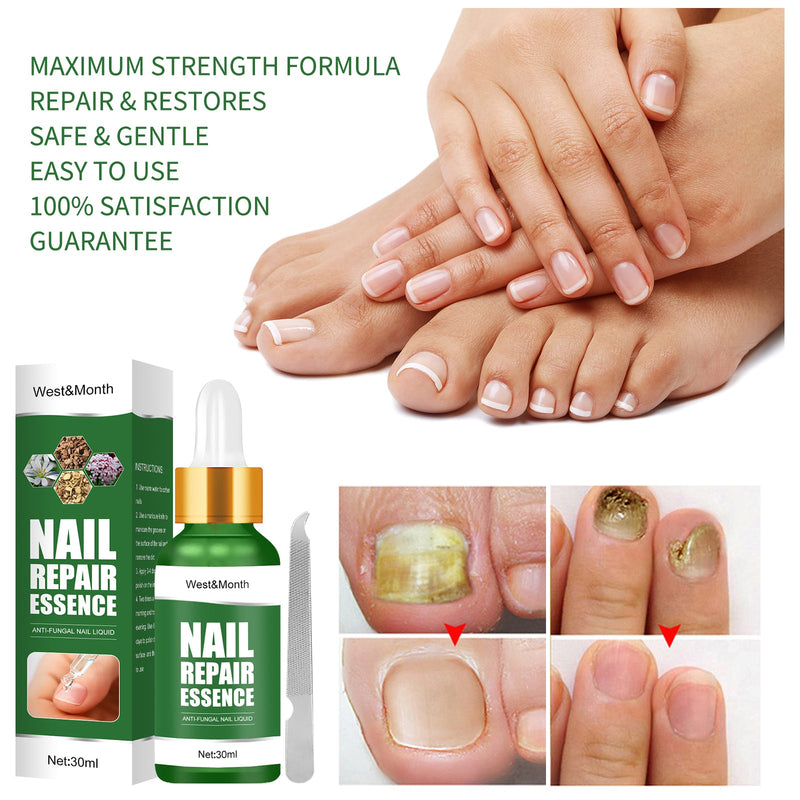 West&Month Nail Repair Essence, Hand And Foot Thickening Brightening Nails Repair Rotten Nails Bad Nails Remove Ash Nail Infection Clean