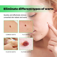 South Moon Skin Tag Removal Rubber Band, Remove Moles Remove Warts Face Neck Flesh Granule Body Cleansing Soap
