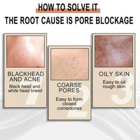 Lactose Solution, Exfoliate Remove Blackheads Shrink Pores Clean And Moisturize SkinEssence