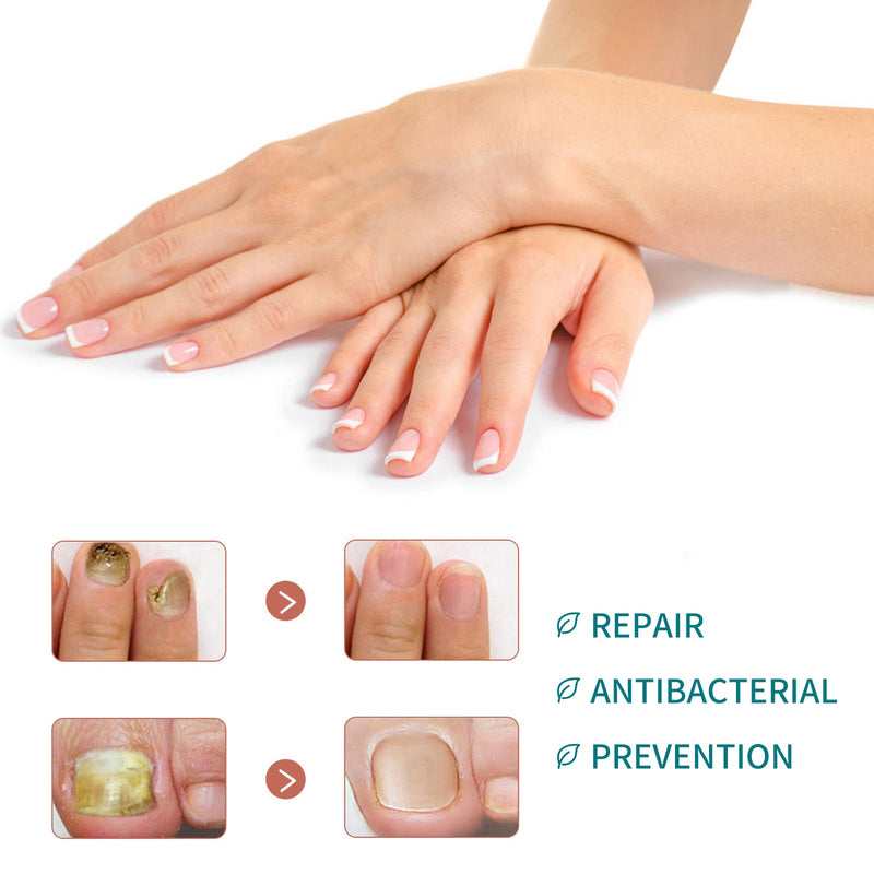 Nail Repair Patch, Hand And Foot Nail Care Soft Nail Inlay Nail Thickening Gray Nails Bright Nails Patch
