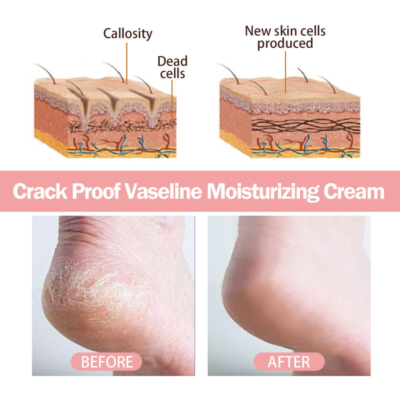Anti-Crack Hand And Foot Moisturizer, Foot Care Anti-Crack And Dead Skin, Hand And Foot Skin Moisturizer