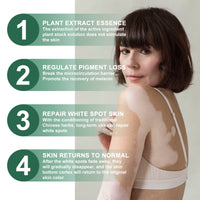South Moon Vitiligo Relief Cream, Repair White Spots Flower Spots Skin Topical Care Ointment
