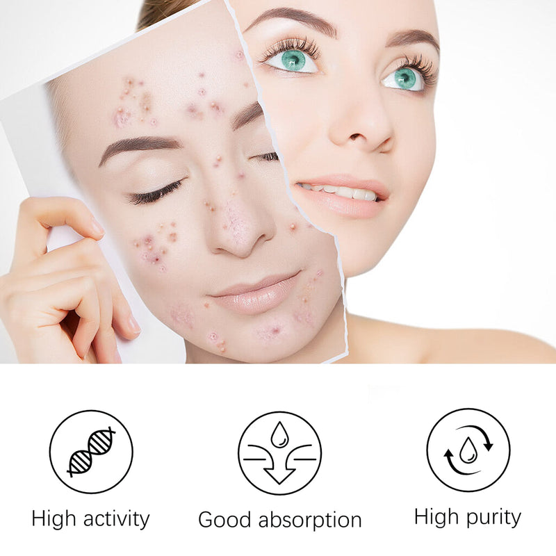 EELHOE Blemish Smoothing Lotion, Reduce Closed Mouth Acne Acne Spot Removal Repair Skin Lotion