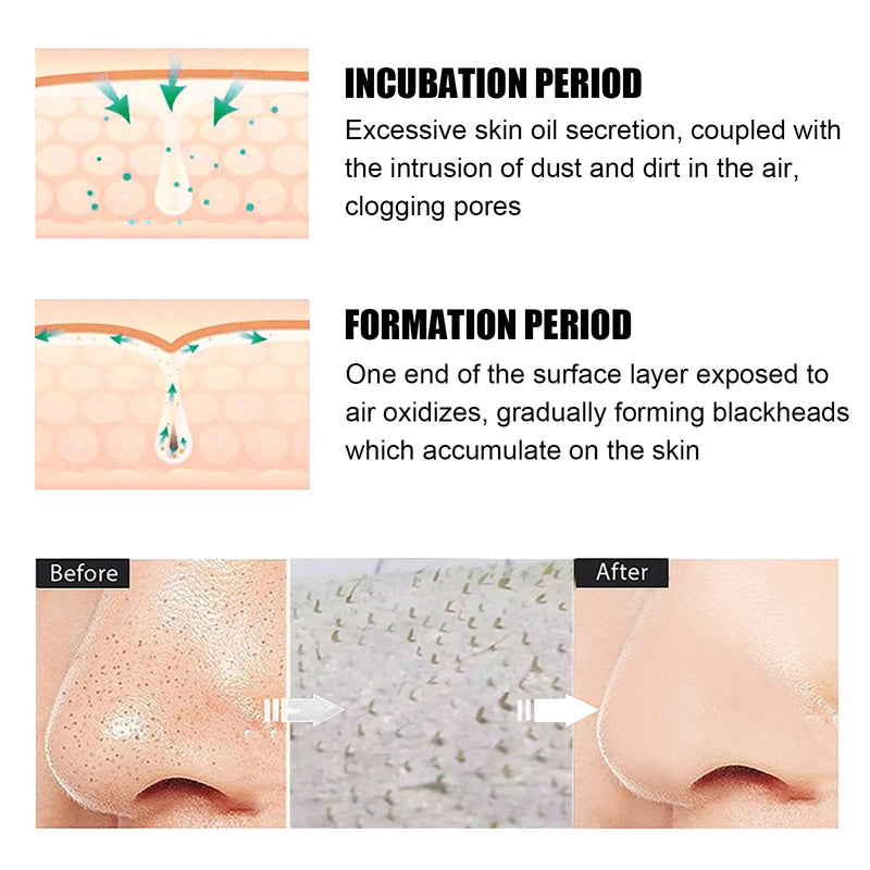 Blackhead Remover Nose Mask, Deeply Cleans And Closes Pore Blackheads And Acne Barbs And Nose Remover Mask