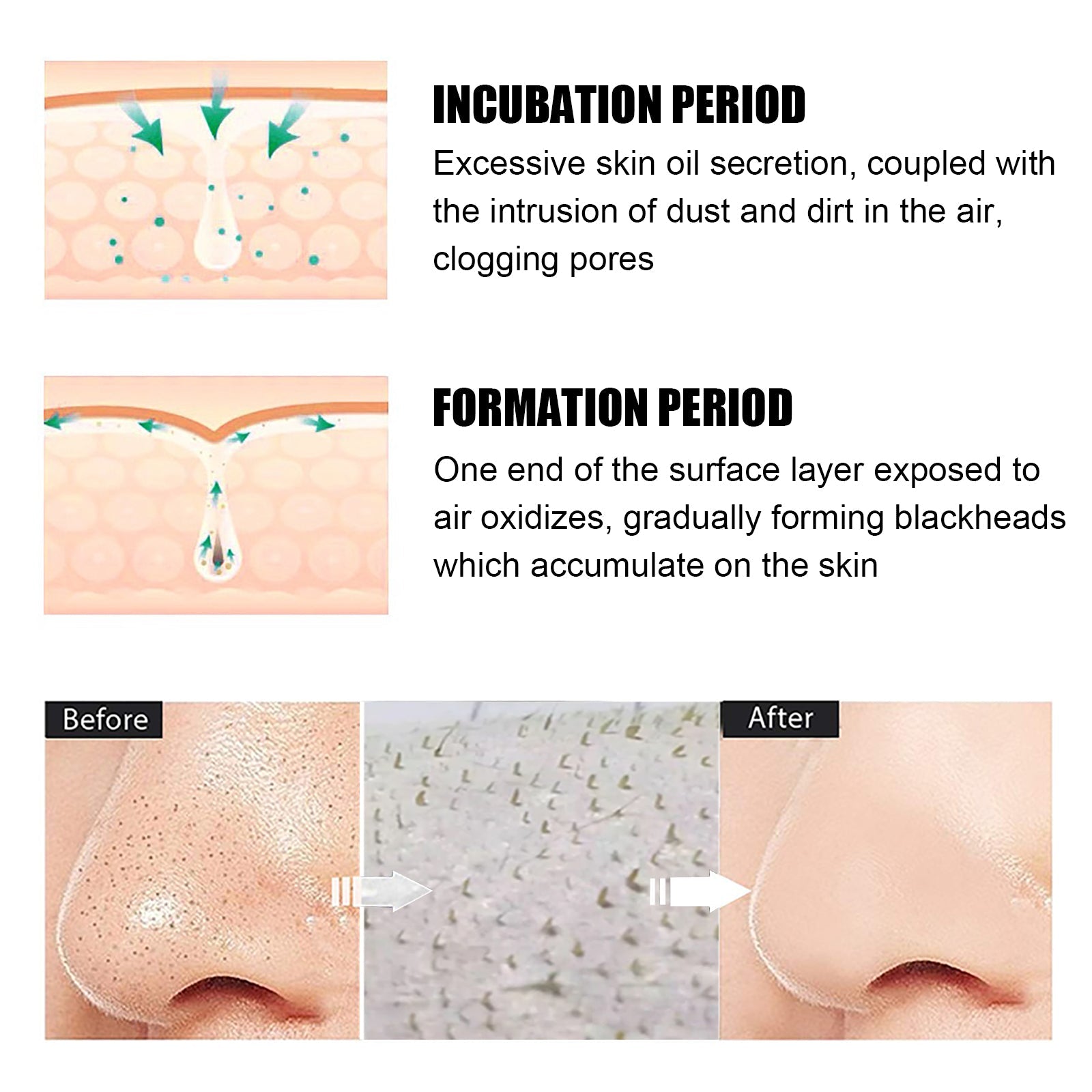 EELHOE Blackhead Remover Nose Mask, Deeply Cleans And Closes Pore Blackheads And Acne Barbs And Nose Remover Mask