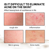 Back Anti-Acne Silk Soap, Body Cleanser Acne Pimple Beauty Back Moisturizing Bath Soap