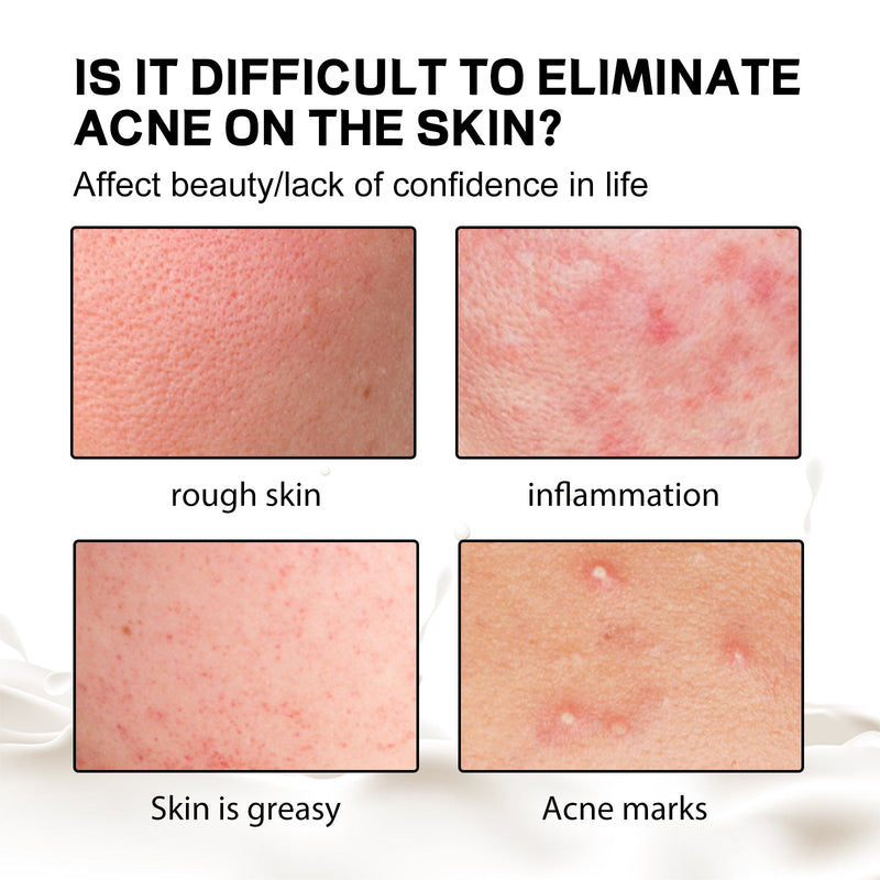 Back Anti-Acne Silk Soap, Body Cleanser Acne Pimple Beauty Back Moisturizing Bath Soap