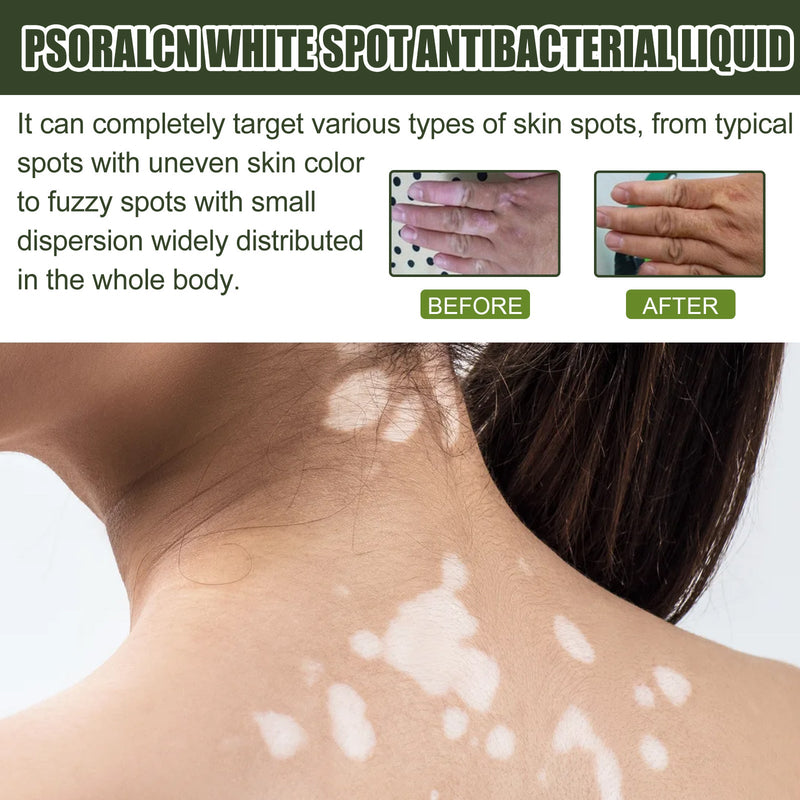 EELHOE White Spot Purifying Serum For Whitening And Repairing White Spot Spot And Perspiration Spot Skin Moisturizing Serum