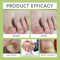 Toenail Repair Set Foot Nail Care Grey Nail Polish Soft Nail Polish Treatment Solution