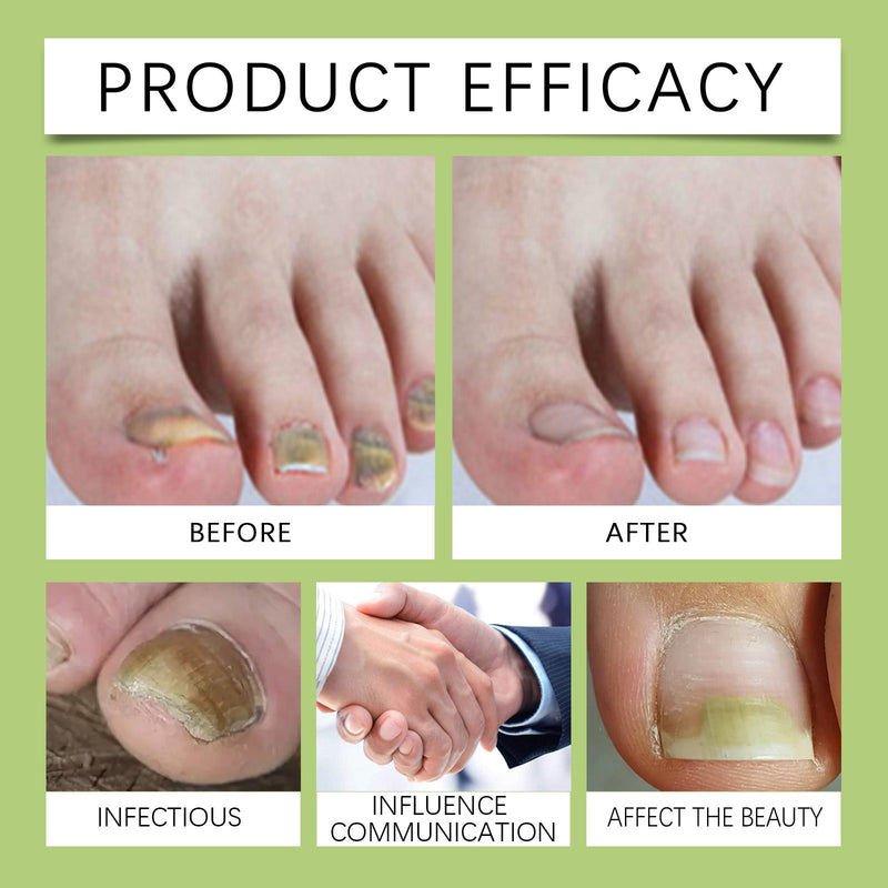 Toenail Repair Set Foot Nail Care Grey Nail Polish Soft Nail Polish Treatment Solution