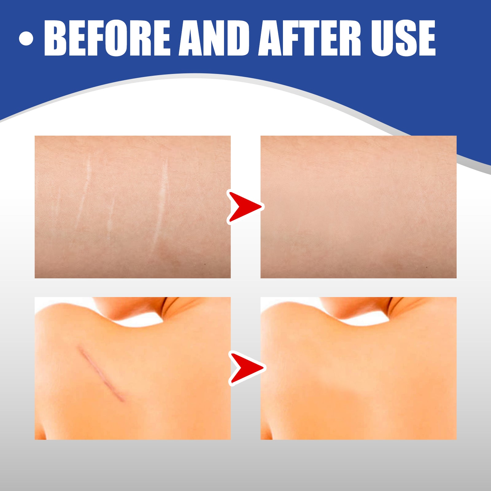 Scar Care Silicone Tape Skin Wound Scar Care Smooth Skin Body Care Patch