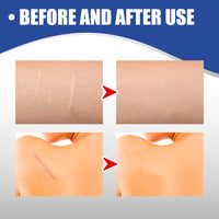 Scar Care Silicone Tape Skin Wound Scar Care Smooth Skin Body Care Patch