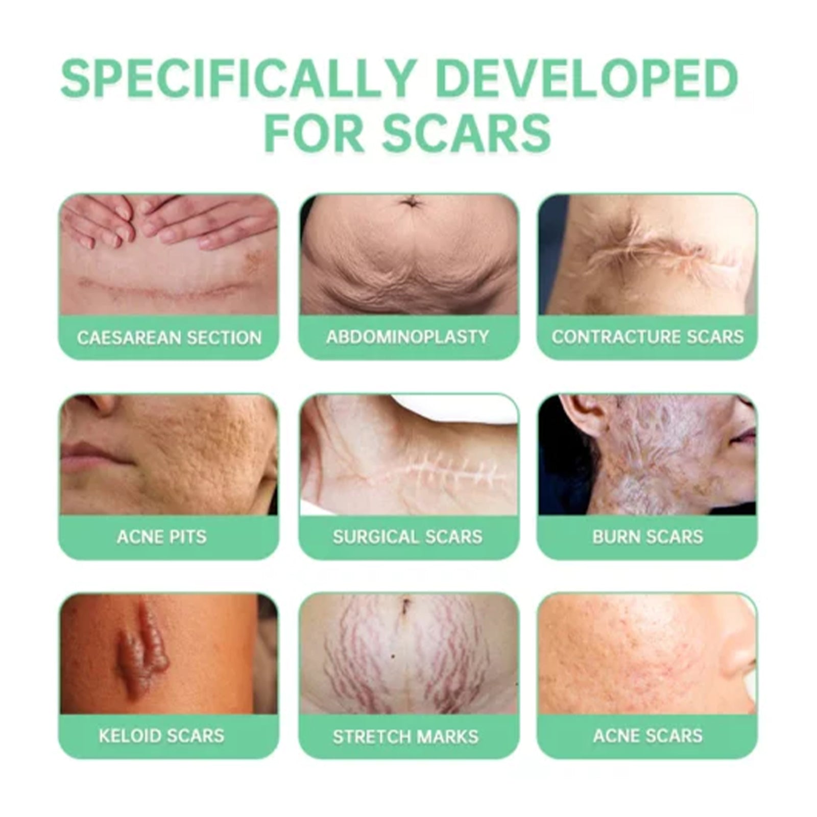 Activated Skin Repairs Spray, Fade Scar Pregnancy Surgery Scar Moisturizing Repair Smooth Skin Care Spray