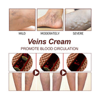 Leg Treatment Cream, Leg Massage Treatment For Leg Discomfort Earthworm Leg Body Treatment Cream