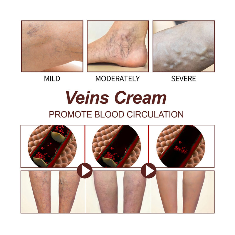 Leg Treatment Cream, Leg Massage Treatment For Leg Discomfort Earthworm Leg Body Treatment Cream