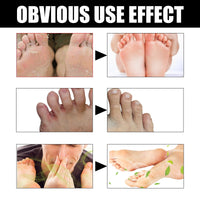 Foot Deodorant Cream, Foot Itch Relief, Beriberi Odor Control, Dry Peeling Cream For Rotten Feet