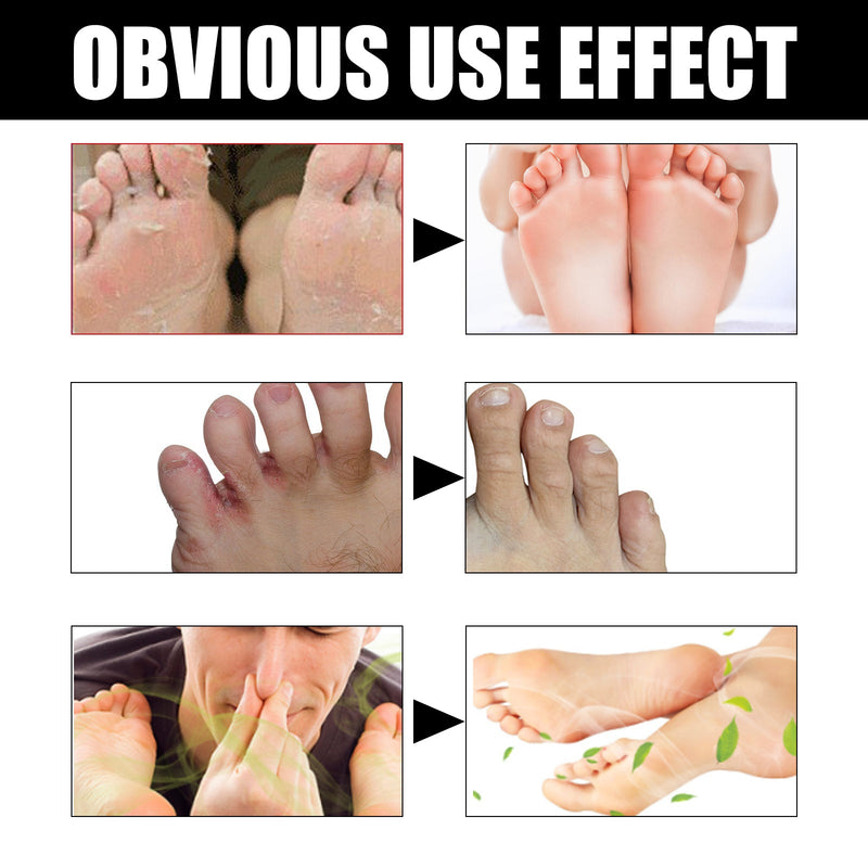 Foot Deodorant Cream, Foot Itch Relief, Beriberi Odor Control, Dry Peeling Cream For Rotten Feet
