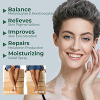 South Moon Vitiligo Relief Cream, Repair White Spots Flower Spots Skin Topical Care Ointment