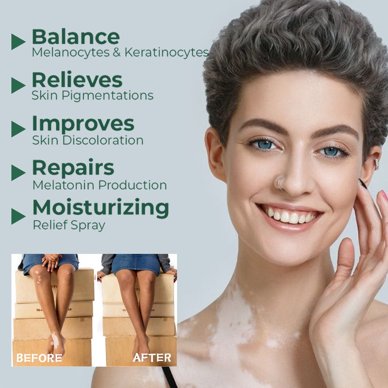 South Moon Vitiligo Relief Cream, Repair White Spots Flower Spots Skin Topical Care Ointment