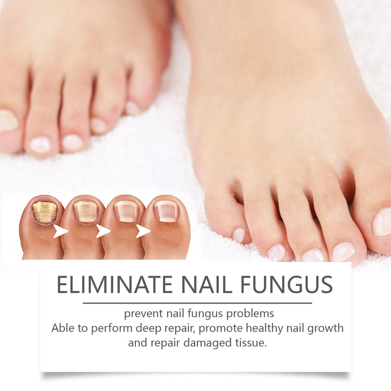 Nail Repair Pen Moisturizes Gently Repair Hands And Feet Gray Nails Soft Nails Thick Nails Foot Care