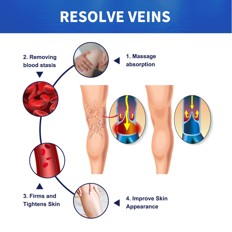 South Moon Vein Massage Varicose Cream Repair Earthworm Legs To Relieve Leg Blood Vessel Bulge And Varicoidea