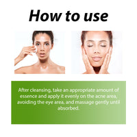 Herbal Acne Serum, Reduce Acne Pimples With A Comprehensive Moisturizing Moisturizer