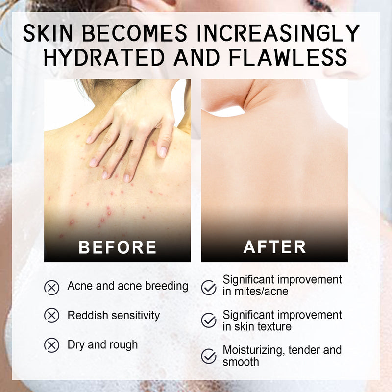 Back Anti-Acne Silk Soap, Body Cleanser Acne Pimple Beauty Back Moisturizing Bath Soap