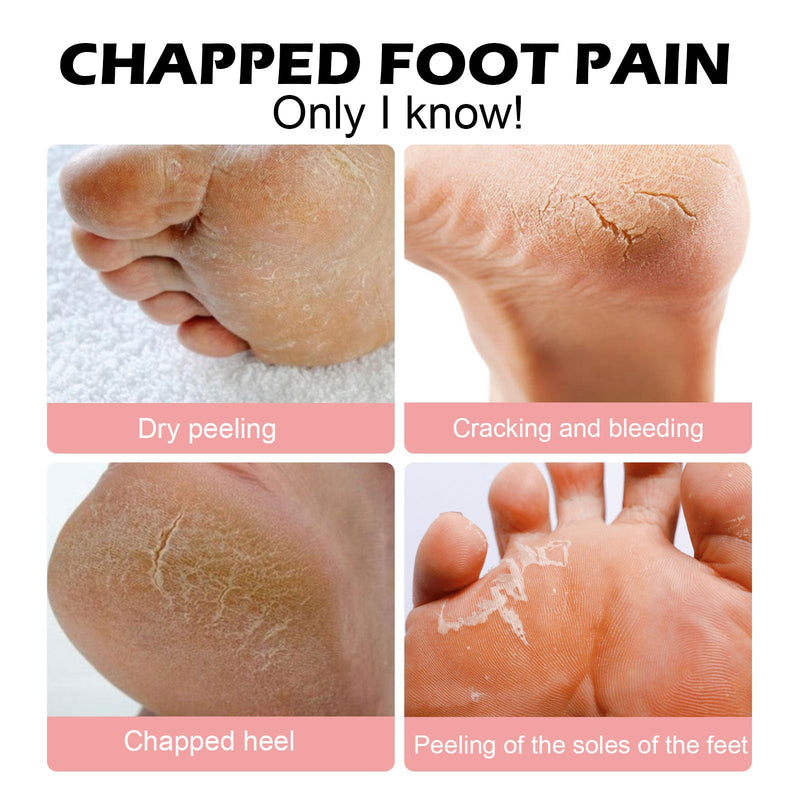 Anti-Crack Hand And Foot Moisturizer, Foot Care Anti-Crack And Dead Skin, Hand And Foot Skin Moisturizer