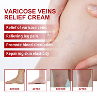 South Moon Varicose Veins Cream, Leg Massage Treatment Soreness Relief Repair Varicose Body Care Cream