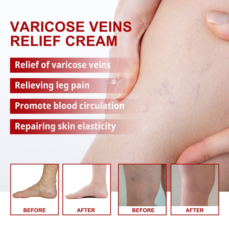 South Moon Varicose Veins Cream, Leg Massage Treatment Soreness Relief Repair Varicose Body Care Cream