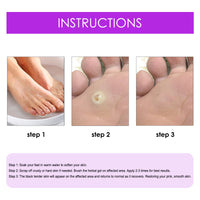 South Moon Remove Chicken Eye Lotion Extra Clear Remove Corns Skin Care Chicken Calluses Foot Pad Gram Warts