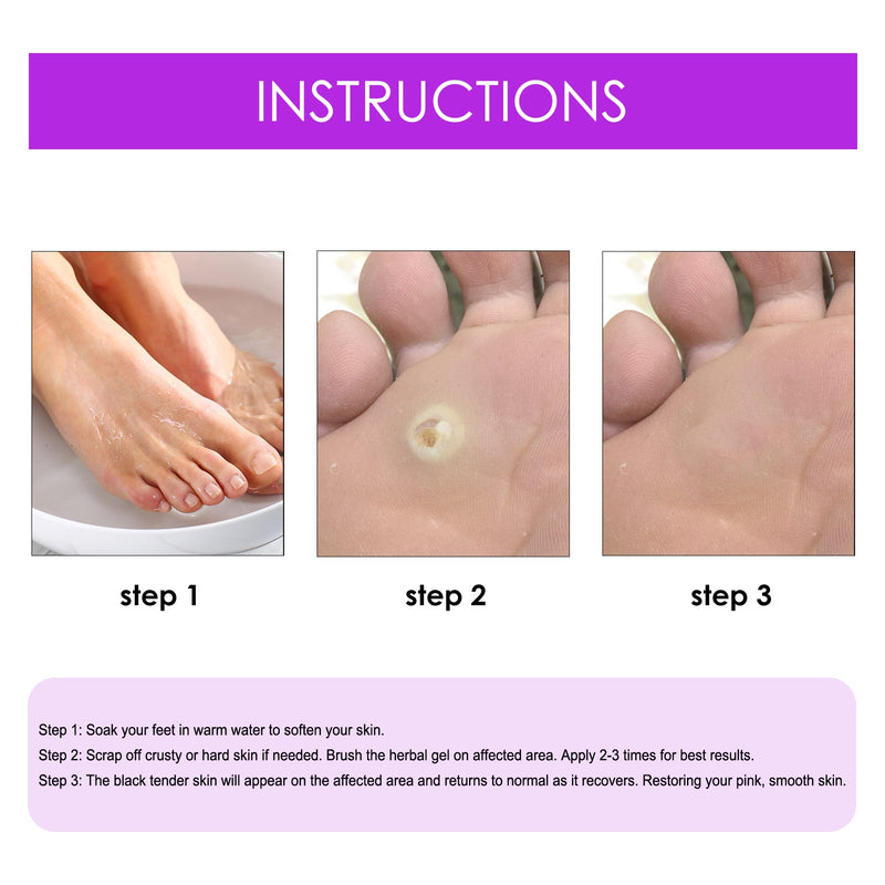 South Moon Remove Chicken Eye Lotion Extra Clear Remove Corns Skin Care Chicken Calluses Foot Pad Gram Warts
