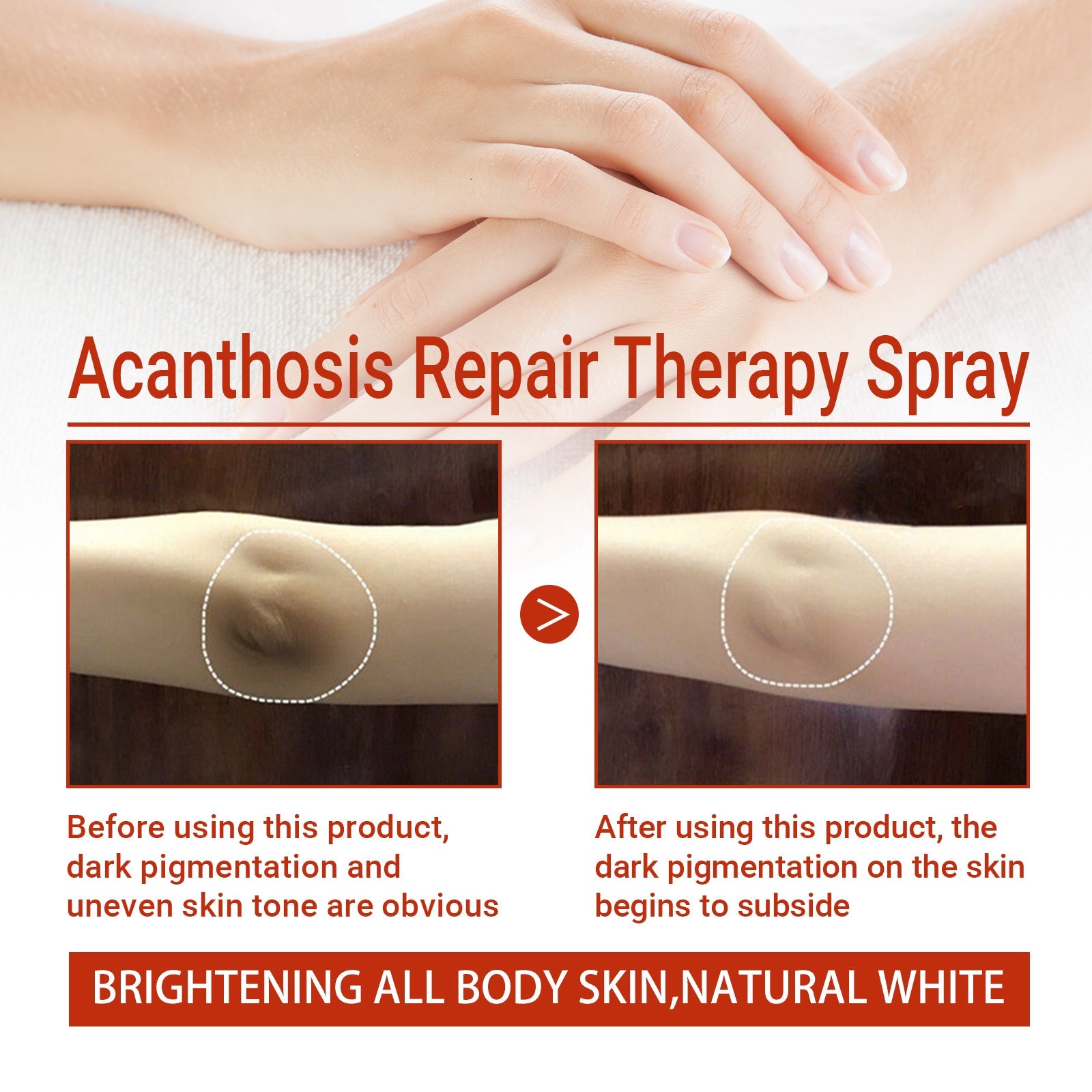 Black Acanthoderma Treatment Spray Cleanses Horny Joints Black Whitening Spray Melanin Repair Underarms