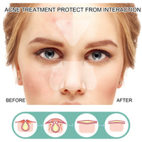 EELHOE Acne Patch Mild Non-Irritating Facial Pores Skin Cleansing Comfort Patch