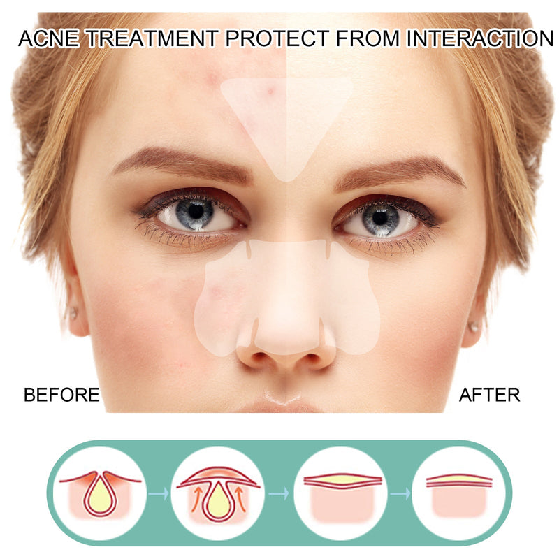 EELHOE Acne Patch Mild Non-Irritating Facial Pores Skin Cleansing Comfort Patch