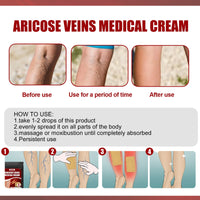 Aricose Veins Medical Cream, Relieve Leg Swelling Earthworm Leg Vein Massage To Relieve Pain