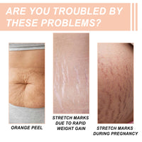 Snail Essence Pregnancy Stretch Mark Cream, Firming Skin Repair Lighten Postpartum Pregnancy Marks And Gestational Fat Smoothing Cream