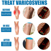 South Moon Leg Care Spray Gently Relieve Leg Discomfort, Blue Veins And Bumps Repair Daily Care