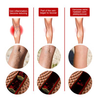 EELHOE Intravenous Massage Spray For Varicose Veins Relief And Earthworm Leg Blood Vessel Bulge Pain Spray