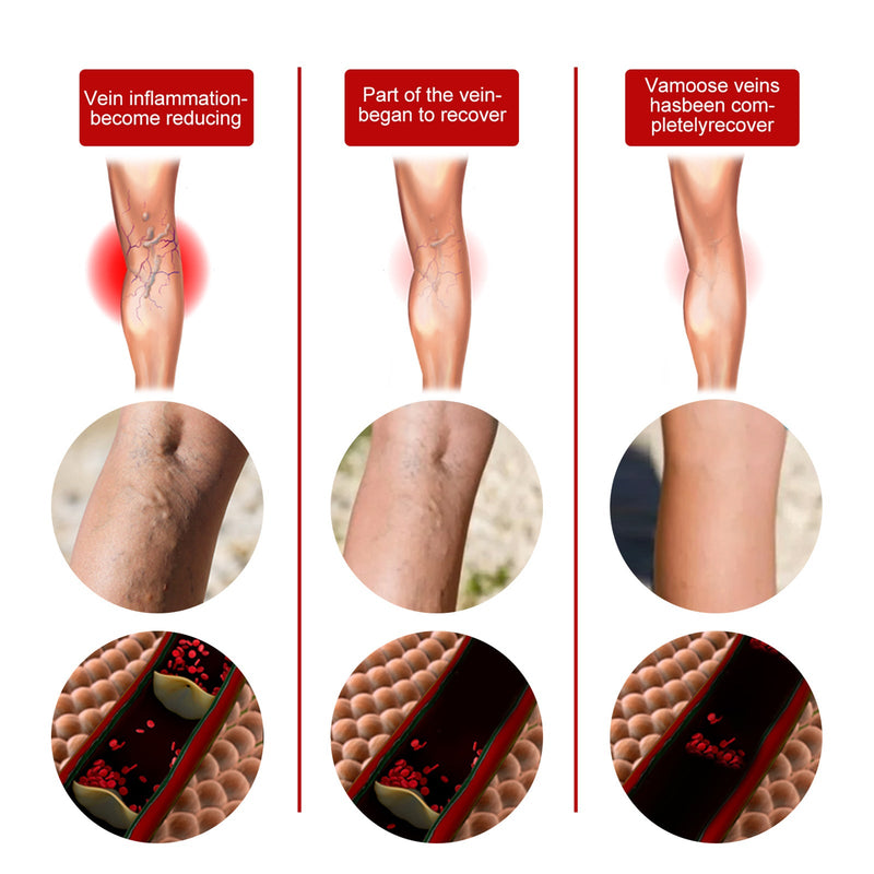 EELHOE Intravenous Massage Spray For Varicose Veins Relief And Earthworm Leg Blood Vessel Bulge Pain Spray