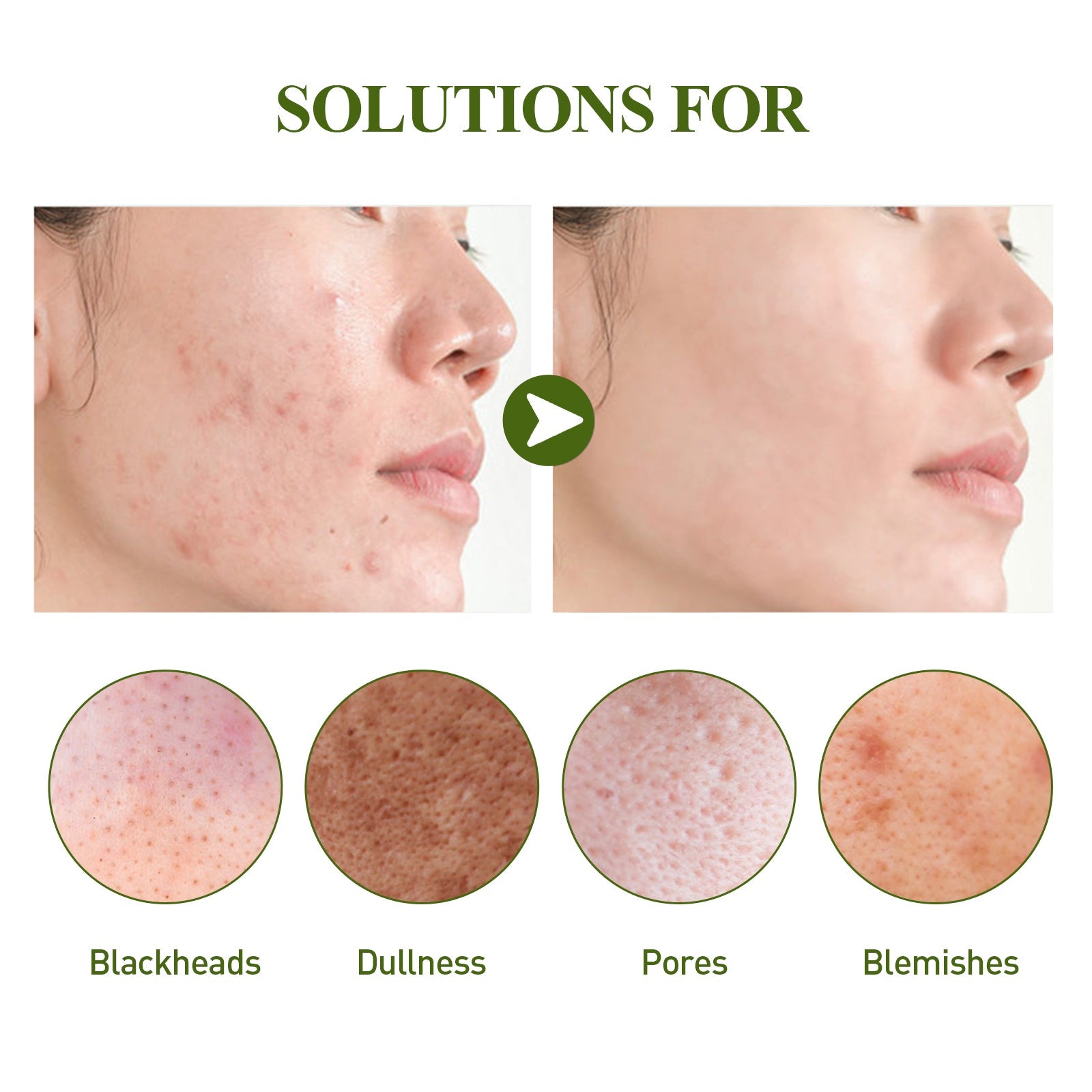 Blackhead Removing Serum Suit, Clean Pores Fine Oil Control Clean Repair Acne Blackhead Nose Patch
