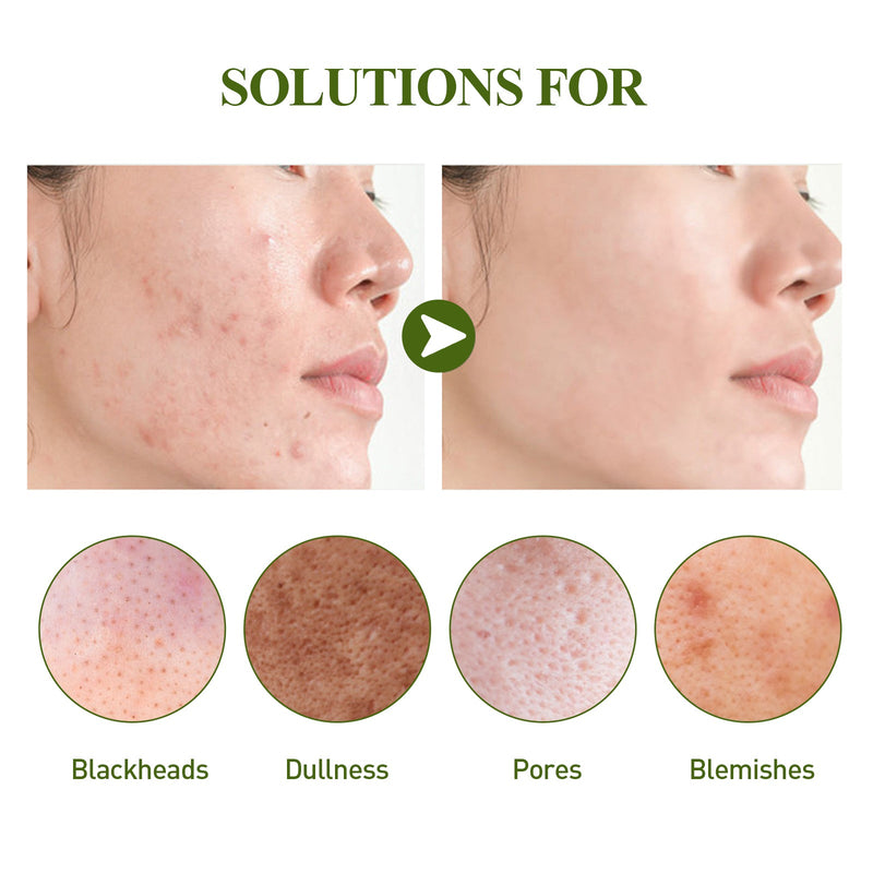 Blackhead Removing Serum Suit, Clean Pores Fine Oil Control Clean Repair Acne Blackhead Nose Patch