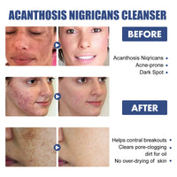 Black Acanthoderm Cleanser Face Deep Clean, Soft And Moisturizing Skin Repair Oil Control Cleansing Cleanser