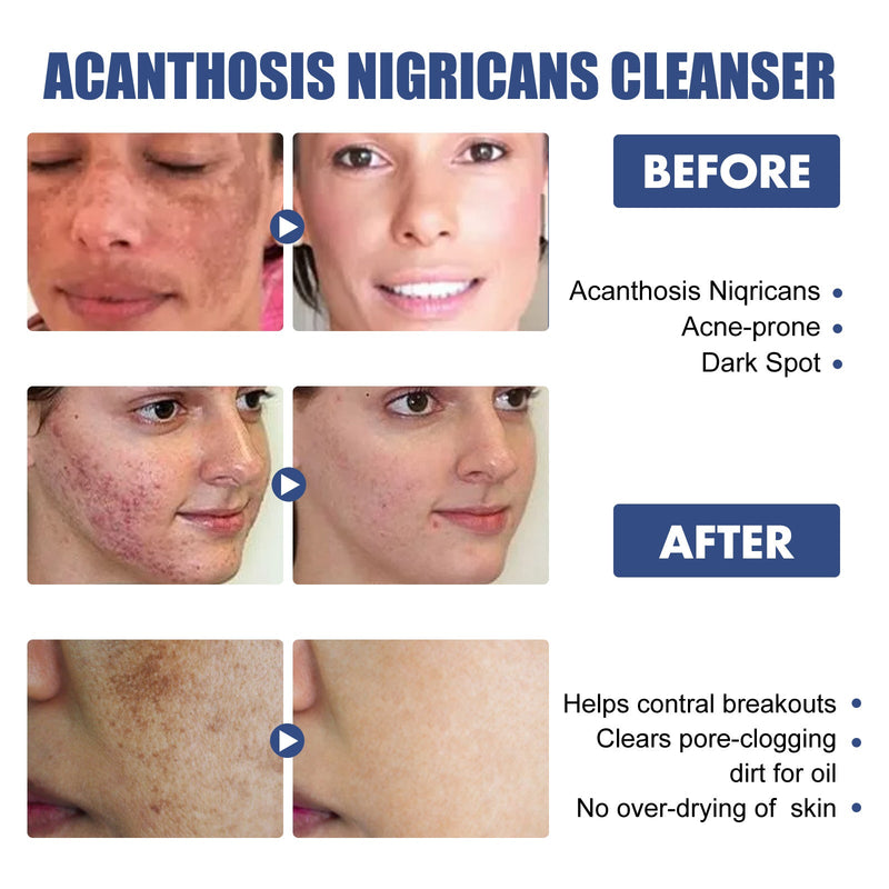 OUHOE Black Acanthoderm Cleanser Face Deep Clean, Soft And Moisturizing Skin Repair Oil Control Cleansing Cleanser