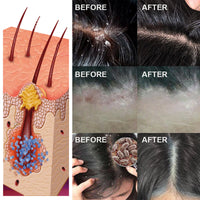 Scalp Serum, Deep Cleansing Follicle Dandruff Repair Hair Smoothing Treatment Essence